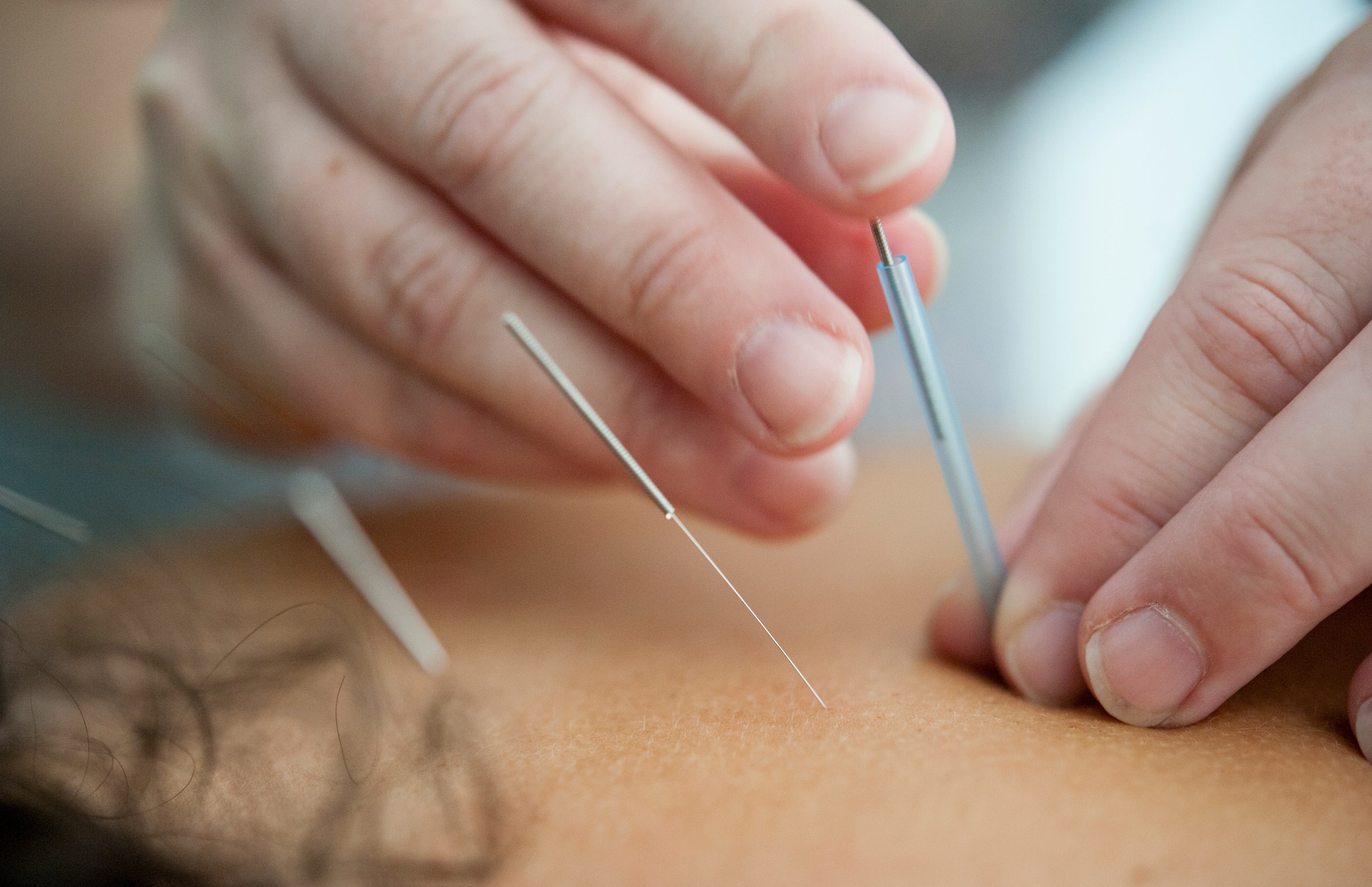 Acupuncture_in_miami_beach.jpg